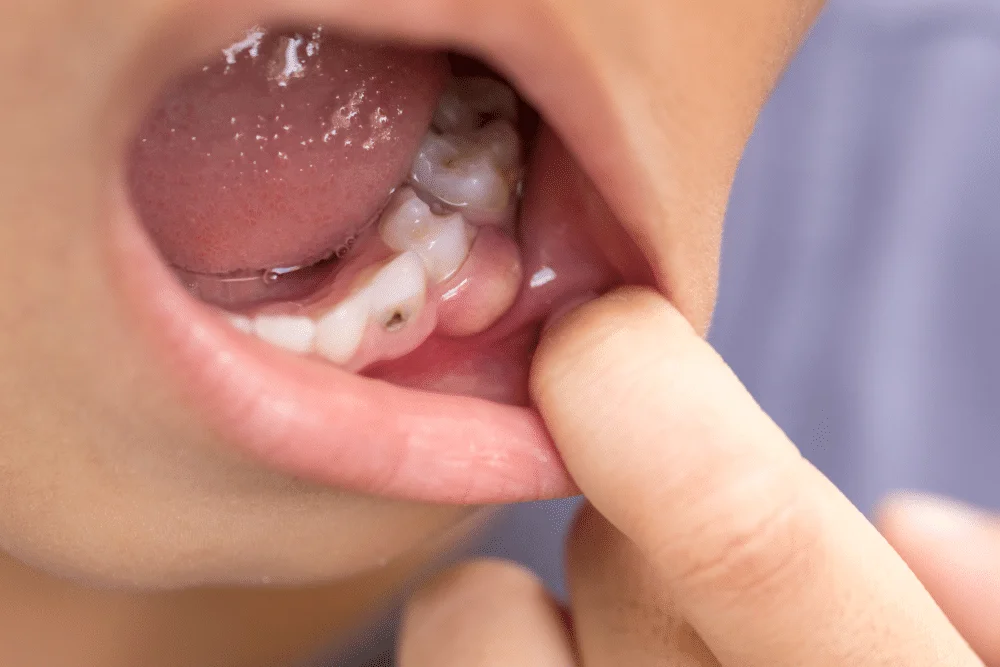 Cauzele și simptomele abcesului dentar la copii