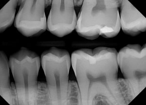 Radiografie dentară bitewing